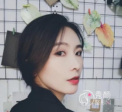 上海华美李健鼻部手术+全脸自体脂肪填充案例。