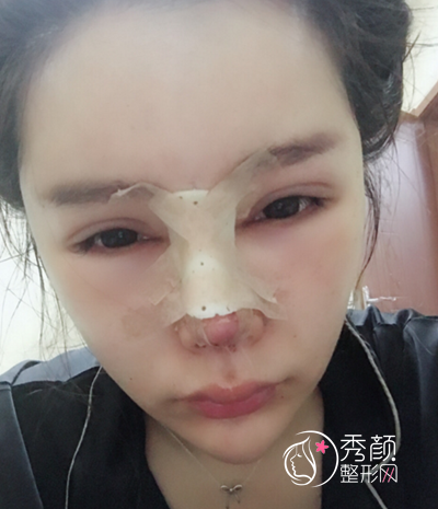 第三次做鼻子了，这一次是在北京做的肋软骨鼻部手术修复案例。