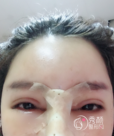 第三次做鼻子了，这一次是在北京做的肋软骨鼻部手术修复案例。