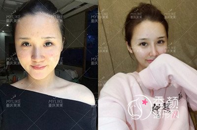 重庆美莱单磊做鼻子怎么样 多少钱 术前术后案例对比