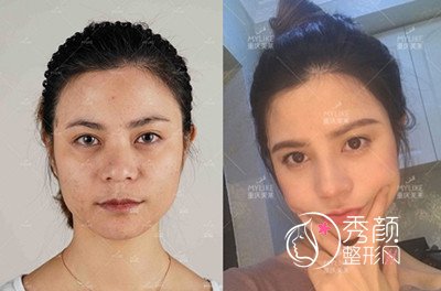 重庆美莱单磊做鼻子怎么样 多少钱 术前术后案例对比