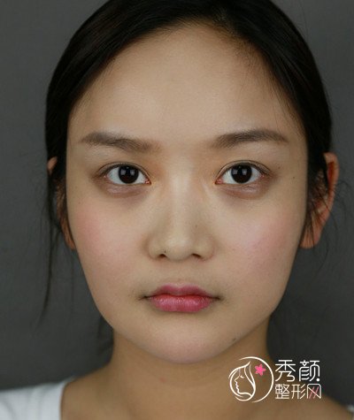 上海磨骨哪个医生好，看首尔丽格朴兴植下颌角整形案例过程分享。