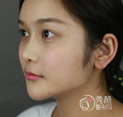 上海磨骨哪个医生好，看首尔丽格朴兴植下颌角整形案例过程分享。