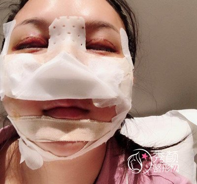 上海磨骨哪个医生好,看首尔丽格朴兴植下颌角整形案例过程分享。