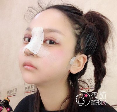 上海磨骨哪个医生好,看首尔丽格朴兴植下颌角整形案例过程分享。