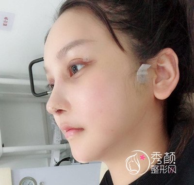 上海磨骨哪个医生好,看首尔丽格朴兴植下颌角整形案例过程分享。