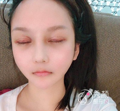 上海磨骨哪个医生好,看首尔丽格朴兴植下颌角整形案例过程分享。
