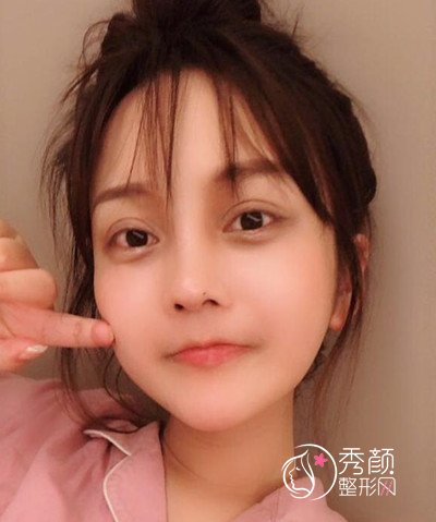 上海磨骨哪个医生好,看首尔丽格朴兴植下颌角整形案例过程分享。