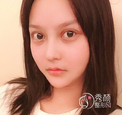 上海磨骨哪个医生好,看首尔丽格朴兴植下颌角整形案例过程分享。