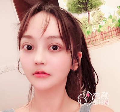 上海磨骨哪个医生好,看首尔丽格朴兴植下颌角整形案例过程分享。