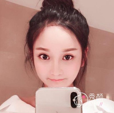 上海磨骨哪个医生好,看首尔丽格朴兴植下颌角整形案例过程分享。