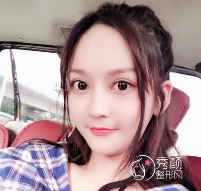 上海磨骨哪个医生好,看首尔丽格朴兴植下颌角整形案例过程分享。