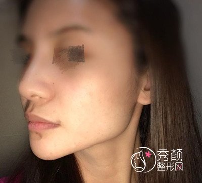 八大处磨骨谁好,八大处下颌角整形案例。
