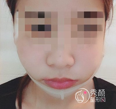 八大处磨骨谁好,八大处下颌角整形案例。
