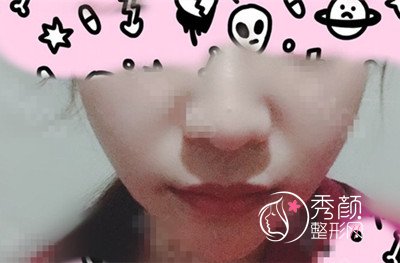 八大处磨骨谁好,八大处下颌角整形案例。