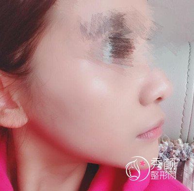八大处磨骨谁好,八大处下颌角整形案例。