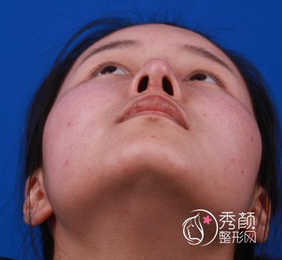 鼻部整形医生欧阳春隆鼻案例。