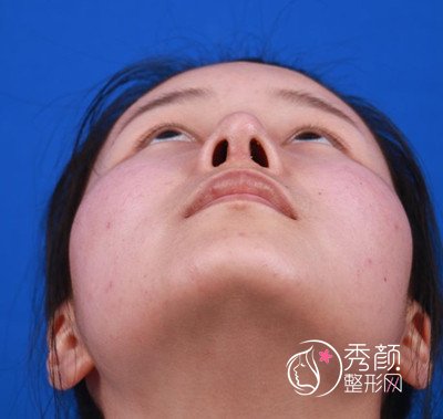 鼻部整形医生欧阳春隆鼻案例。
