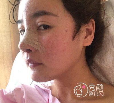 分享一下我的第五次鼻修复之路,上海伯思立徐晓斐鼻修复近一年。