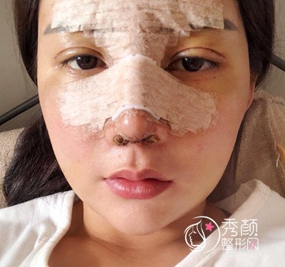 上海华美李健肋骨鼻修复花了69800,看看我做的咋样。