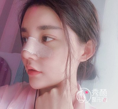 上海华美李健肋骨鼻修复花了69800，看看我做的咋样。