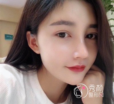 上海华美李健肋骨鼻修复花了69800，看看我做的咋样。