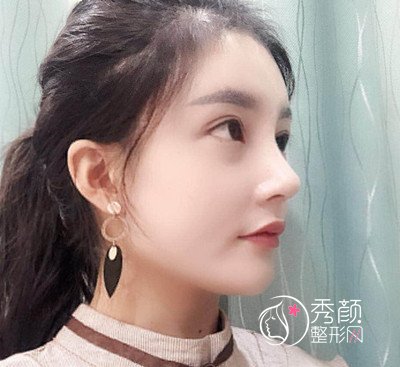 上海华美李健肋骨鼻修复花了69800,看看我做的咋样。