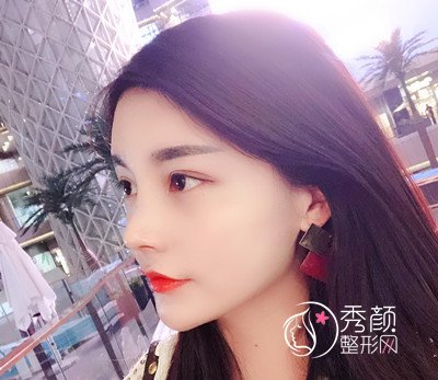 上海华美李健肋骨鼻修复花了69800，看看我做的咋样。