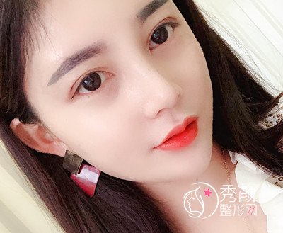 上海华美李健肋骨鼻修复花了69800,看看我做的咋样。