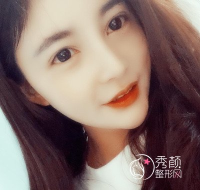 上海华美李健肋骨鼻修复花了69800，看看我做的咋样。