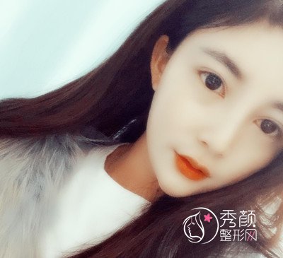上海华美李健肋骨鼻修复花了69800,看看我做的咋样。