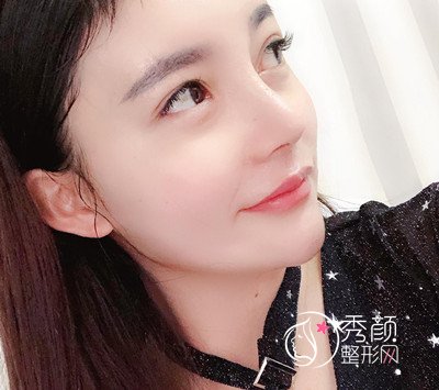 上海华美李健肋骨鼻修复花了69800，看看我做的咋样。