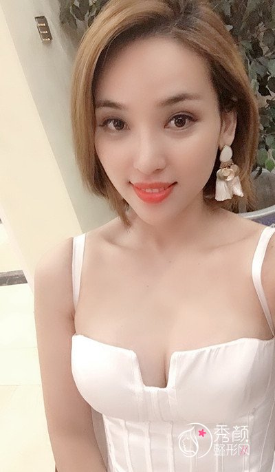 花了88000在上海华美李健做的假体隆胸手术半年。