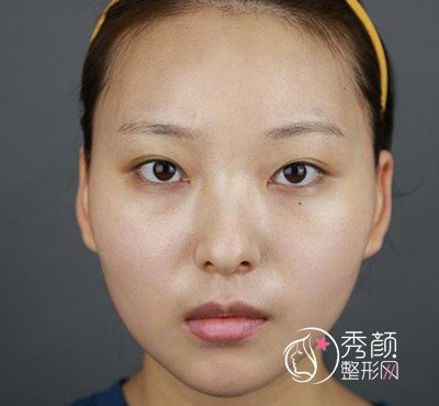 上海首尔丽格朴相根做的双眼皮术后半个月分享。