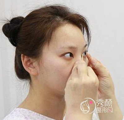 上海首尔丽格朴相根做的双眼皮术后半个月分享。