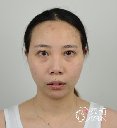 上海首尔丽格朴兴植上下颚手术/突嘴矫正案例。