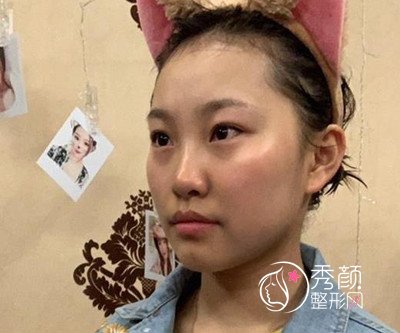 北京加减美面部提升案例,年轻不止10岁哦。