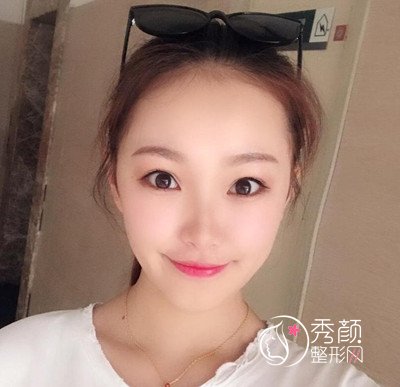 北京加减美面部提升案例,年轻不止10岁哦。