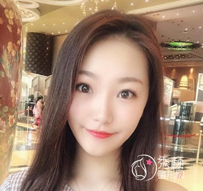 北京加减美面部提升案例,年轻不止10岁哦。