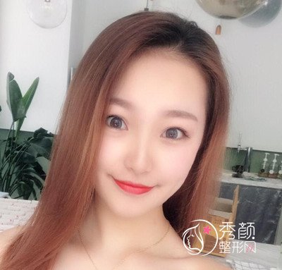 北京加减美面部提升案例,年轻不止10岁哦。