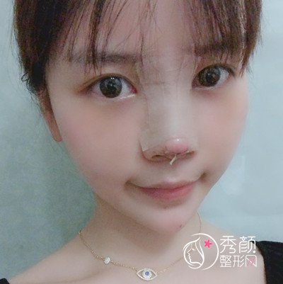 上海时光整形外科医院做的鼻部手术手术，感谢医美的存在。