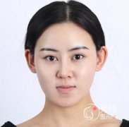 终于做了凸嘴矫正（地包天）手术，上海时光何晋龙医生让我重生。