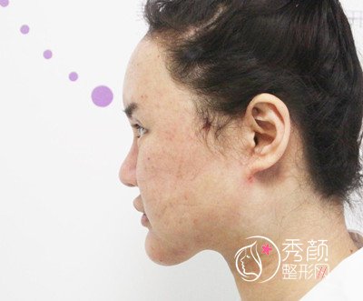 北京禾美嘉任学会自体脂肪面部填充案例过程分享。