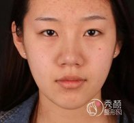 北京美莱做的眼部手术手术，大眼睛对于我来说再也不是梦。