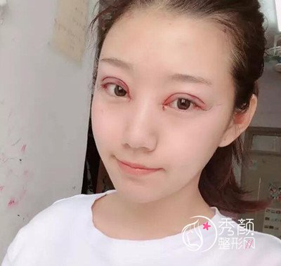 北京美莱做的眼部手术手术，大眼睛对于我来说再也不是梦。