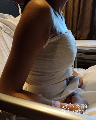 上海隆胸哪儿好，上海艺星唐毅假体隆胸案例过程分享。