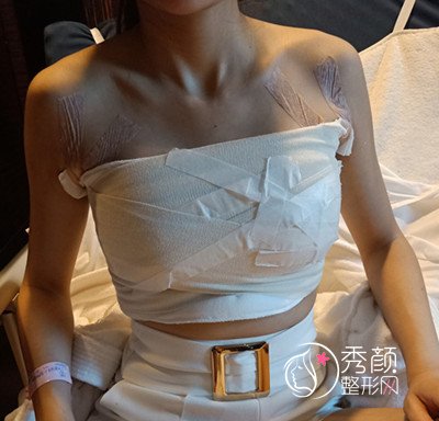 上海隆胸哪儿好，上海艺星唐毅假体隆胸案例过程分享。