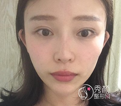 大连爱德丽格刘志刚双眼皮修复案例过程分享。