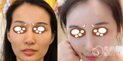 <b>脂肪填充上海九院孙宝珊和曹卫刚谁好?收费贵吗?</b>