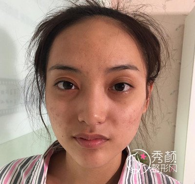 北京隆鼻哪个医生好,薛志强肋软骨鼻部手术案例分享。